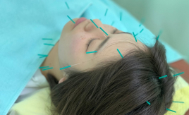 東栄鍼灸整骨院 美顔鍼　美顔コースのメニュー画像