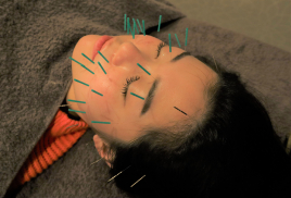 SKY鍼灸整骨院 美容鍼のメニュー画像