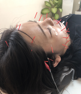 岡山鍼灸院 美容鍼のメニュー画像