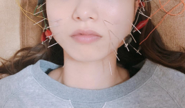 HARIN スタンダード美容鍼のメニュー画像