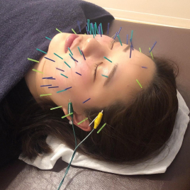 SKY鍼灸整骨院 オプション（リフトアップ電気鍼）のメニュー画像