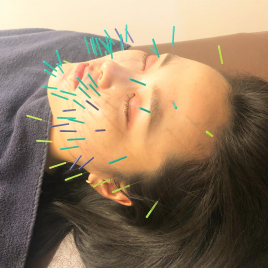 SKY鍼灸整骨院 オプション（10本鍼追加）のメニュー画像
