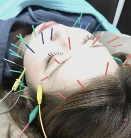 さくら整体院・さくら鍼灸接骨院 美容鍼（美顔鍼）のメニュー画像