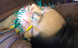 鍼灸院 叶 〜kanai〜 美容鍼・小顔整体 スタンダード（90分）のメニュー画像