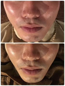 鍼灸院 叶 〜kanai〜 美容鍼・小顔整体 ロング（120分）のメニュー画像