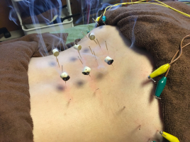 鍼灸院 叶 〜kanai〜 局所治療（１部位）のメニュー画像