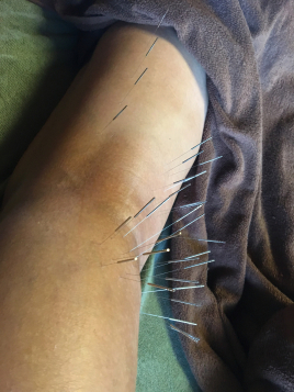 鍼灸院 叶 〜kanai〜 全身治療（３部位）のメニュー画像