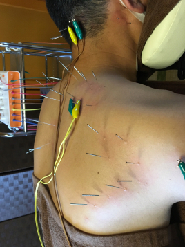 鍼灸院 叶 〜kanai〜 なんでも治す痛みの治療のメニュー画像