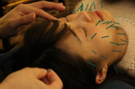 美容・鍼灸サロンS４ 美容鍼のメニュー画像