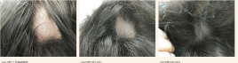 カラダケア　アクプンクト 円形脱毛症のメニュー画像