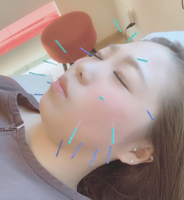 鍼灸サロン　Happiness 美容はりコース【顔+手足施術】のメニュー画像