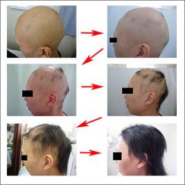 三瓶鍼療院 成人型脱毛、男性型脱毛・円形脱毛症の治療のメニュー画像
