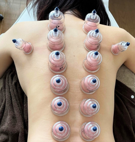 鍼灸サロンMEGAMI カッピング（吸玉療法）のメニュー画像