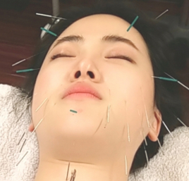 美笑鍼灸院 美しさを保つお顔のお悩み鍼灸のメニュー画像