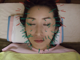 ほり鍼灸院・HORI美容整体院 美容の「華」     鍼100本コースのメニュー画像