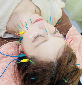 チキバンはり・きゅうサロン 美容鍼プレミアム【初回　7,000円】のメニュー画像