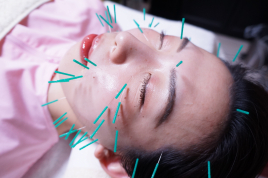 雅鍼灸院 ◆【しみ・しわ】美顔鍼灸コースのメニュー画像