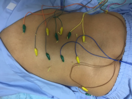 訪問・出張専門　はり・きゅう・マッサージの小石川 はり低周波通電療法のメニュー画像