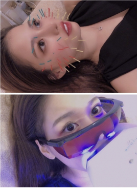 鍼灸整骨院Refine 美容鍼+ホワイトニングのメニュー画像