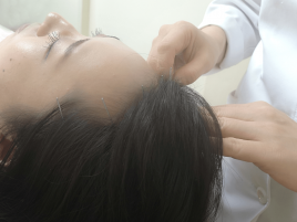 アサンキヤはりきゅう院 頭皮美養鍼灸(髪の美容鍼)100本コースのメニュー画像