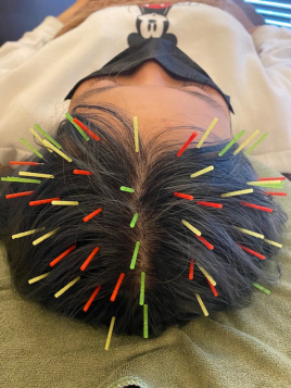 Acupuncture salon LINOA リノア鍼灸院 ヘッドスパ鍼のメニュー画像