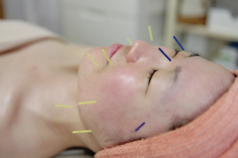 鍼灸サロンMinori 美容鍼　クイックコースのメニュー画像