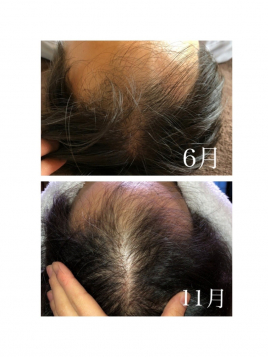 鍼灸サロン　ZEN 頭皮鍼×強髪プログラムのメニュー画像