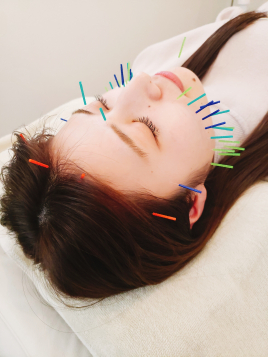 おもいやり鍼灸治療院 美容鍼スタンダード(70本)のメニュー画像