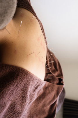 久留米 美容鍼灸院warmly  鍼灸治療［全身］のメニュー画像