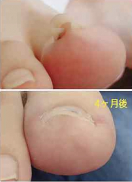 はな鍼灸治療院 巻き爪ケアのメニュー画像