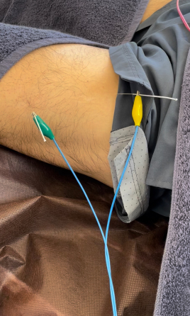 アクア治療院 ランナー鍼治療のメニュー画像