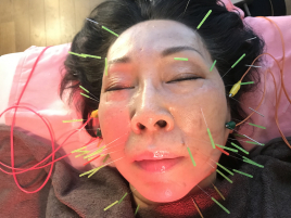 Salon Mari Mari（木下鍼灸院） 美容鍼のメニュー画像