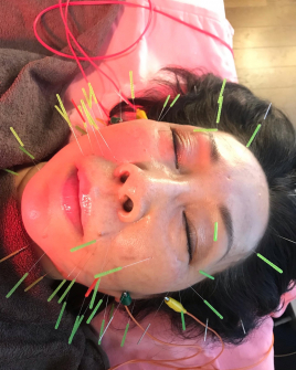 Salon Mari Mari（木下鍼灸院） 美容鍼×ラジオ波フェイシャルのメニュー画像