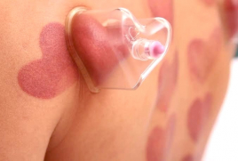 アクア治療院 ♡お背中のカッピング♡10のメニュー画像