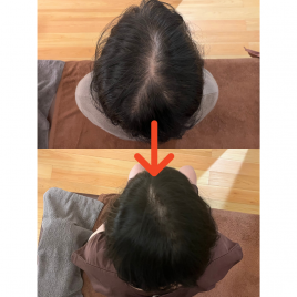 ミトノマチ鍼灸整体院 薄毛治療（初回トライアル）のメニュー画像