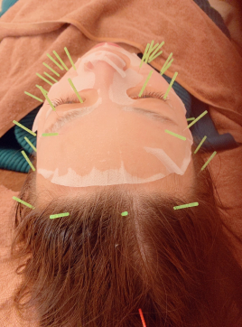 さきこ鍼灸院 ヒト幹細胞パック美容鍼のメニュー画像