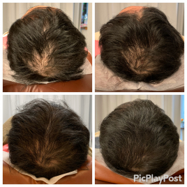 【ダイエット・育毛鍼】鍼灸院Roots　宝塚院 再生育毛鍼カウンセリングのメニュー画像