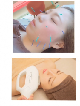 鍼灸サロン　Happiness 美容鍼×光フォトコースのメニュー画像