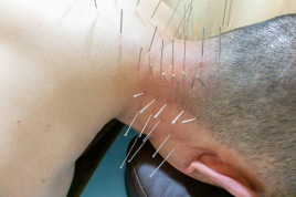 北京堂鍼灸 練馬 基本鍼治療コースのメニュー画像