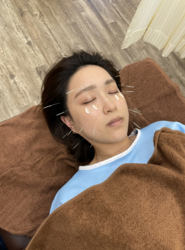 松本はりきゅう施術院 美容鍼　施術　のメニュー画像