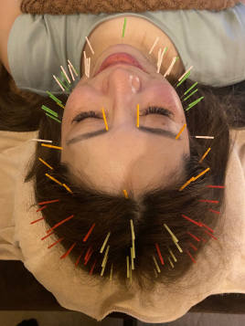 Acupuncture salon LINOA リノア鍼灸院 美容鍼×美髪鍼のメニュー画像