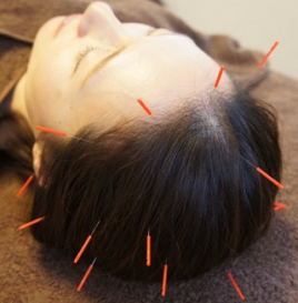 上田端はり灸院 頭鍼コースのメニュー画像