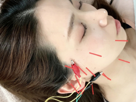 Yui Yui Maruはりとヨガ 美容鍼（ヘッドスパ・EMS・お灸付き）のメニュー画像