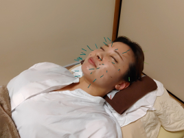 鍼灸治療院ハセガワ本院 美容鍼施術　６０分コースのメニュー画像