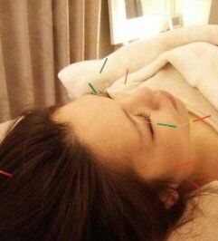 あおい鍼灸院 美容鍼灸のメニュー画像