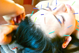 美浜鍼灸接骨院 コクア式美容鍼のメニュー画像