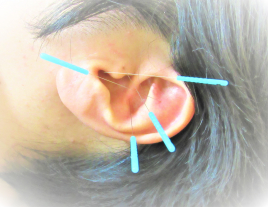 大塚鍼灸院 治療メニュー 6.　耳つぼ鍼灸のメニュー画像