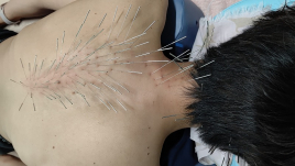 鍼灸マッサージ　蒲田のむすび ルート治療のメニュー画像