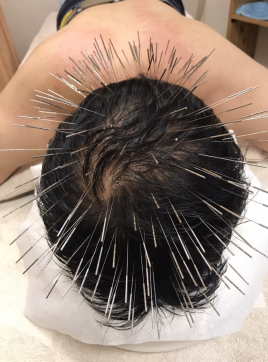 鍼灸マッサージ　蒲田のむすび ルート薄毛治療のメニュー画像