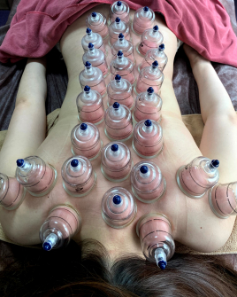 美容鍼灸サロン　etoile カッピング×INDIBAのメニュー画像